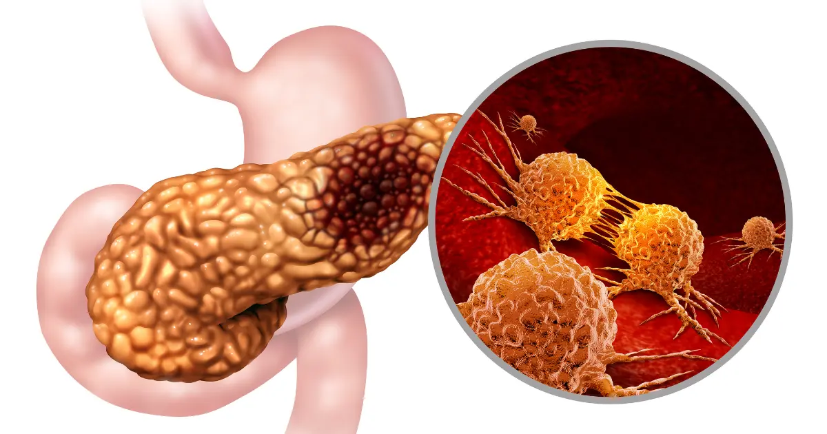 cancer-de-pancreas:-como-identificar-os-sinais-sutis-de-um-vilao-silencioso-e-assintomatico